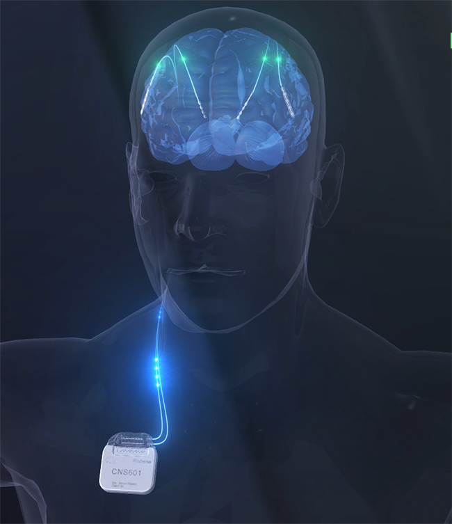 瑞神安医疗“植入式脑深部神经刺激器系统（CNS）”正式获批上市(图4)