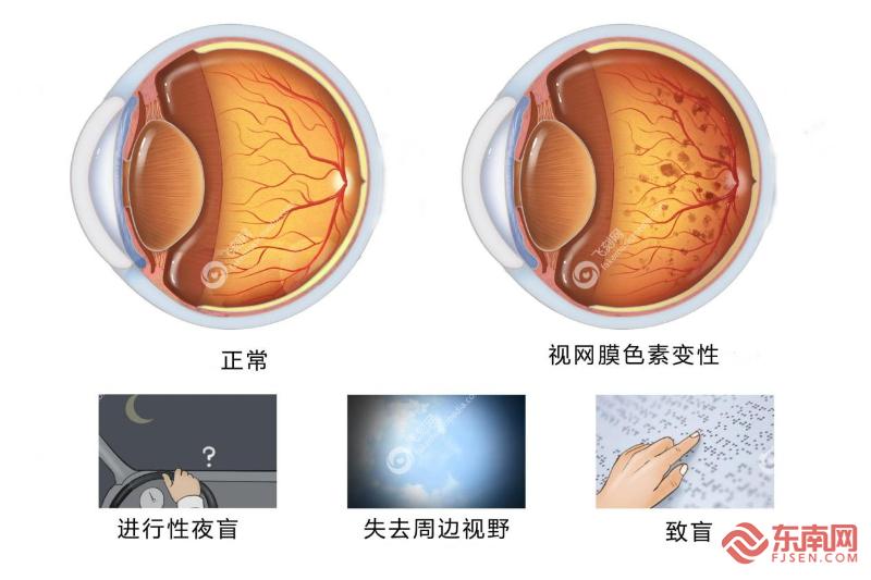 宁德市医院精准诊断罕见病为患者点亮希望之光(图1)